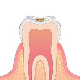 C1：歯の表面だけの「エナメル質う蝕」
